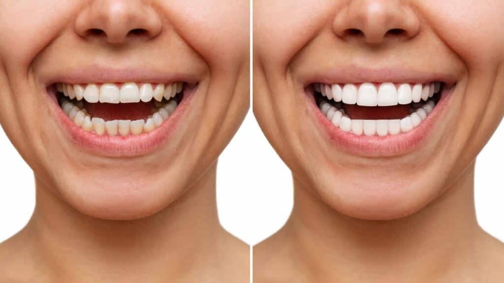 Before and after teeth whitening results. Kettering