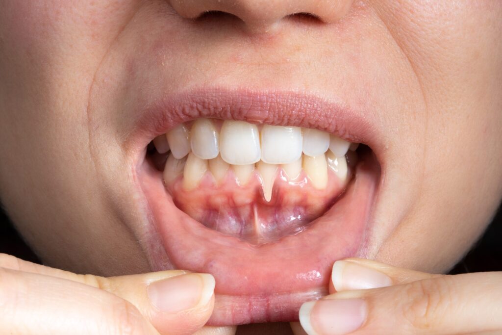 Preparing for teeth whitening with receding gums Kettering